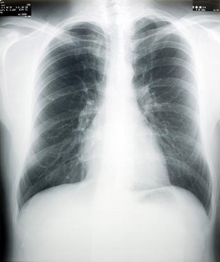 lung and chest x-ray