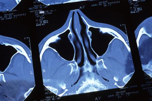 head CT scan